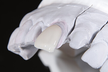 ラミネートベニア